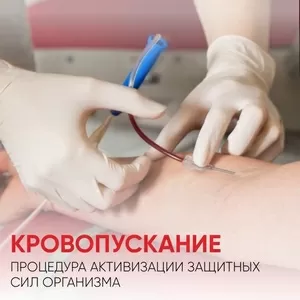 Кровопускание при мигренях сосудистого типа 